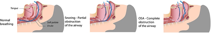 Diagram of sleep apnea
